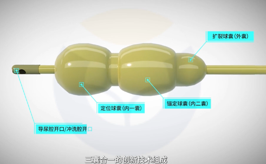 超微创智慧版柱状水囊前列腺新扩开术让两位高龄患者重获畅快人生